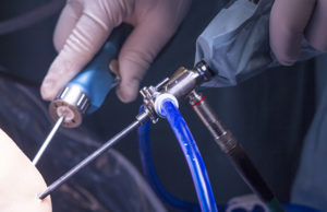 Minimally invasive knee surgery catheters 