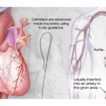 cardiac-catheterization