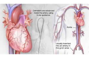 cardiac catheterization procedure