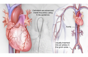 cardiac-catheterization