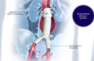 AFX Endovascular AAA System endovascular stent grafts FDA