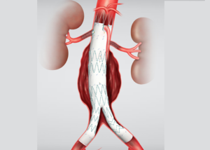 Zenith Fenestrated AAA endovascular graft Cook Medical