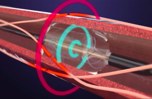 This ReCor Medical illustration shows how its Paradise renal denervation catheter system works.