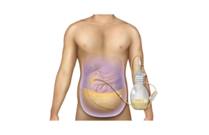 BD PeritX peritoneal catheter