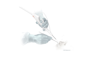 3NT Medical single-use sinus endoscope