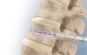 Medtronic Kyphon balloon kyphoplasty spine fracture