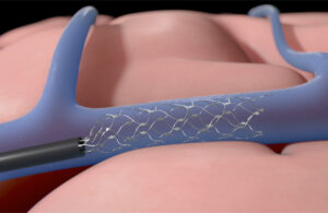 Synchron’s Stentrode device expands inside a blood vessel on the brain to relay motor signals. 