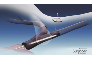 Surfacer-Inside-Out-Bluegrass-Vascular