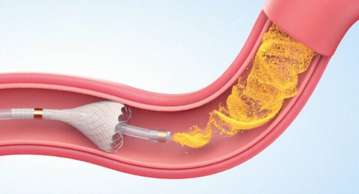 TriSalus releases positive data for its catheter-based drug delivery tech