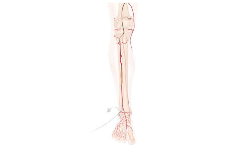 Cook Medical CLTI treatment graphic