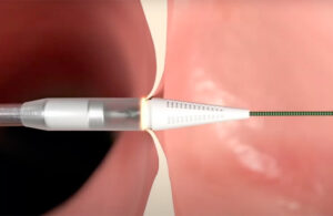 An image from an Alleviant Medical animation that shows the Alleviant System using a short pulse of energy for controlled creation of an interatrial shunt to relieve pressure in the heart's left atrium