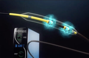 Shockwave-Medical-C2-Plus-IVL-Catheter