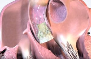 Onecrea Medical Crea aortic valve TAVR_waifu2x_photo_noise1_scale