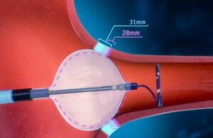 Boston Scientific POLARx Cryoablation system