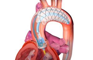 Encompass F2 cerebral embolic protection system