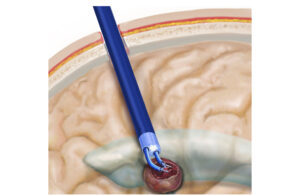 An illustration showing the endoscopic robot removing a brain tumor.