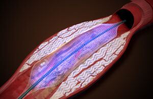 An illustration of an AVS Pulse balloon catheter breaking up arterial calcification while expanding the blood vessel.