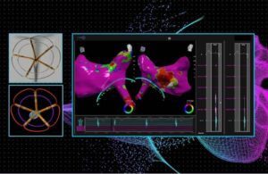 Pulse Biosciences CardioNXT pulsed-field ablation mapping tech