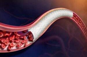 BD Agility Vascular Covered Stent
