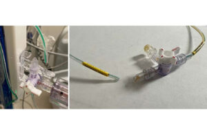 This is an FDA-provided image of Medtronic Duet EMDS catheters disconnected from luer connectors. Some of the catheters were involved in a Class I level recall in 2024.