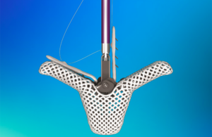A photo of the Abbott TriClip clip heart valve implant.