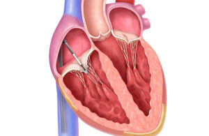 This illustration shows the catheter-delivered TriClip implantation in the tricuspid valve.