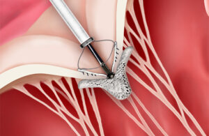 This illustration shows the catheter-delivered TriClip implantation in the tricuspid valve.
