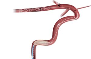 Anaconda Biomed screenshot of AMA Funnel Catheter
