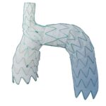 Endospan Nexus aortic arch stent graft