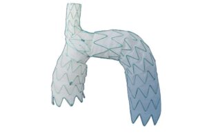 Endospan Nexus aortic arch stent graft