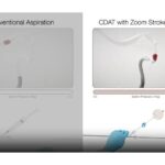 Imperative Care Zoom Stroke System CDAT demonstration