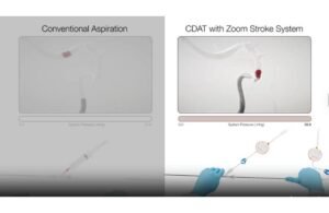 Imperative Care Zoom Stroke System CDAT demonstration