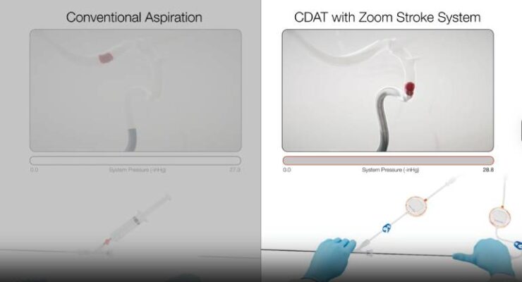 Imperative Care expands Zoom Stroke System with new dual-catheter launch