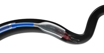 Anaconda Biomed ANA5 funnel catheter in vessel (1)