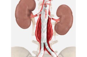 Cook Medical Zenith Fenestrated+ Endovascular Graft (ZFEN+)