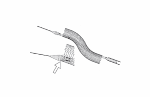 Boston Scientific Carotid WallStent Monorail Endoprosthesis