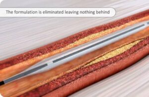 Orchestra BioMed Virtue sirolimus angioinfusion balloon (SAB)