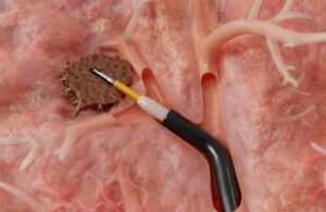 Galvanize Therapeutics Aliya pulsed electric field ablation