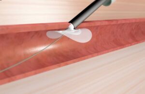 Vivasure PerQSeal Elite vascular closure system screenshot