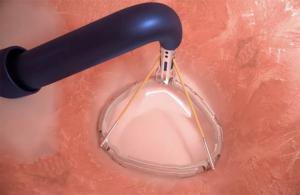 An image of the Valcare annuloplasty system in vivo.