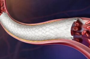 BD Revello Covered Stent CE mark (1) (1)