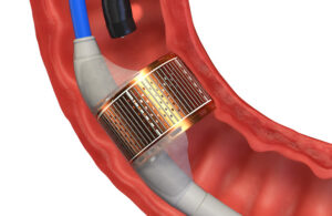 Endogenex-ReCET-catheter