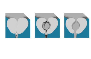 Prodeon Medical Urocross BPH implant