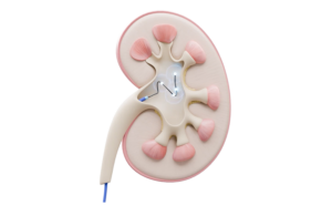 Verve Medical marketing illustration of pelvic renal denervation PRD