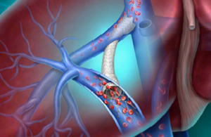 BD Liverty TIPS stent graft for portal hypertension