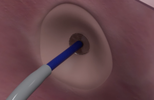Protaryx Medical transseptal puncture device marketing video