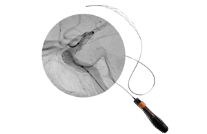 Rapid Medical Tigertriever thrombectomy device