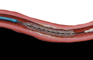 Reflow Medical Spur Retrievable Stent System - 20-05-2026 15-32-49