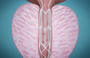 Rivermark Medical FloStent animation