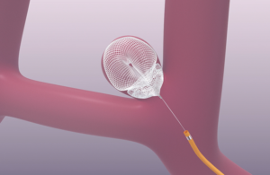 This is a Galaxy Therapeutics illustration of the SEAL embolization system in action.
